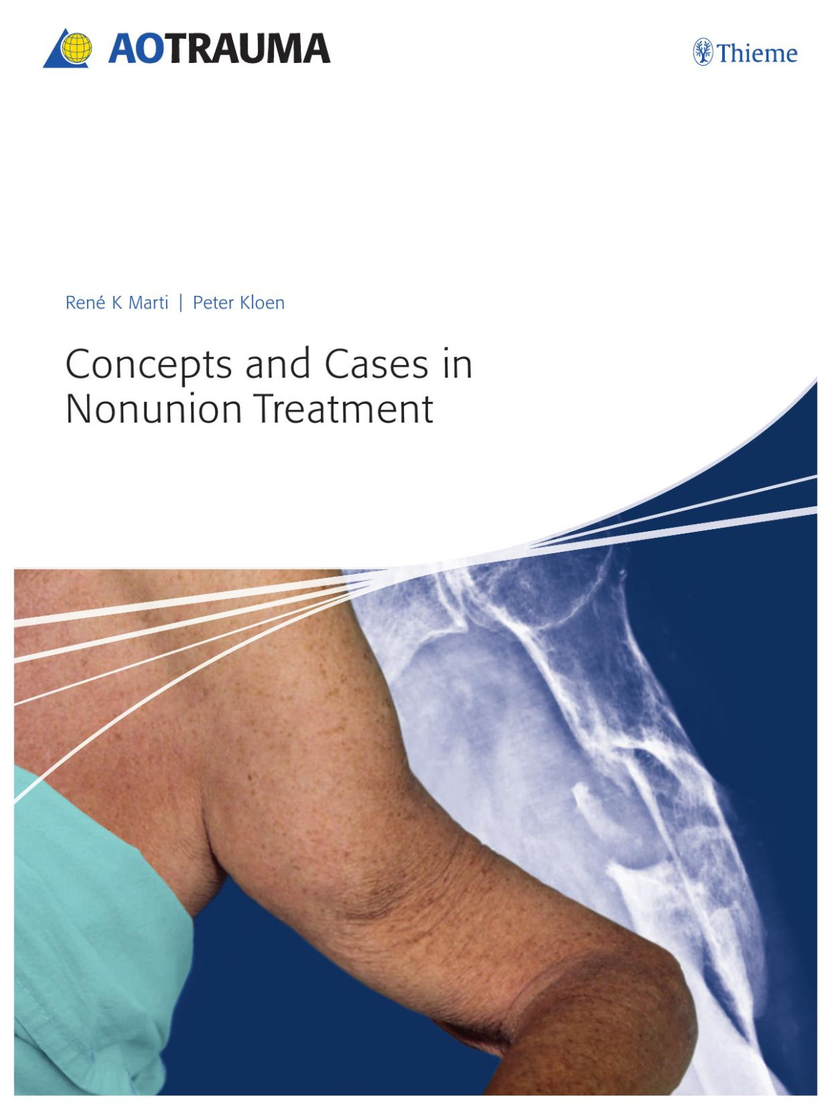 Concepts And Cases In Nonunion Treatment Aotrauma Thieme 2011tls Marti