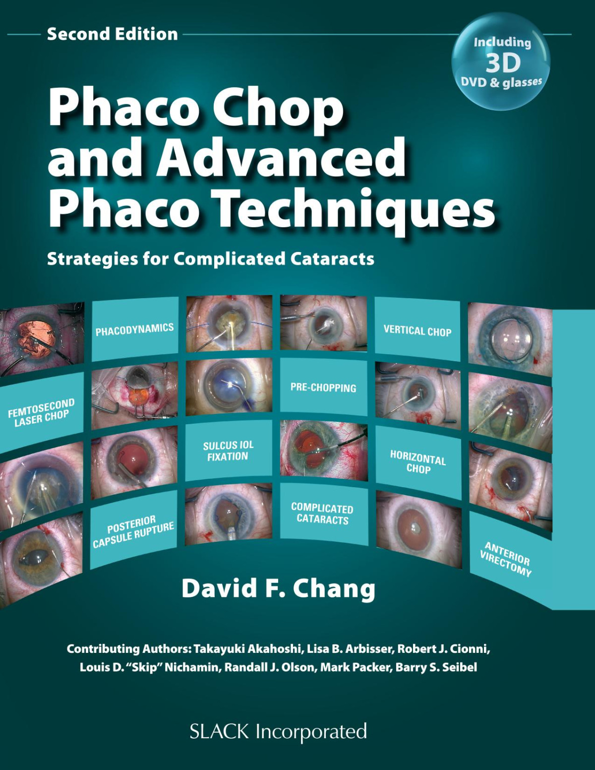 Phaco Chop And Advanced Phaco Techniques Strategies For Complicated Cataracts 2nd Edition David F Chang