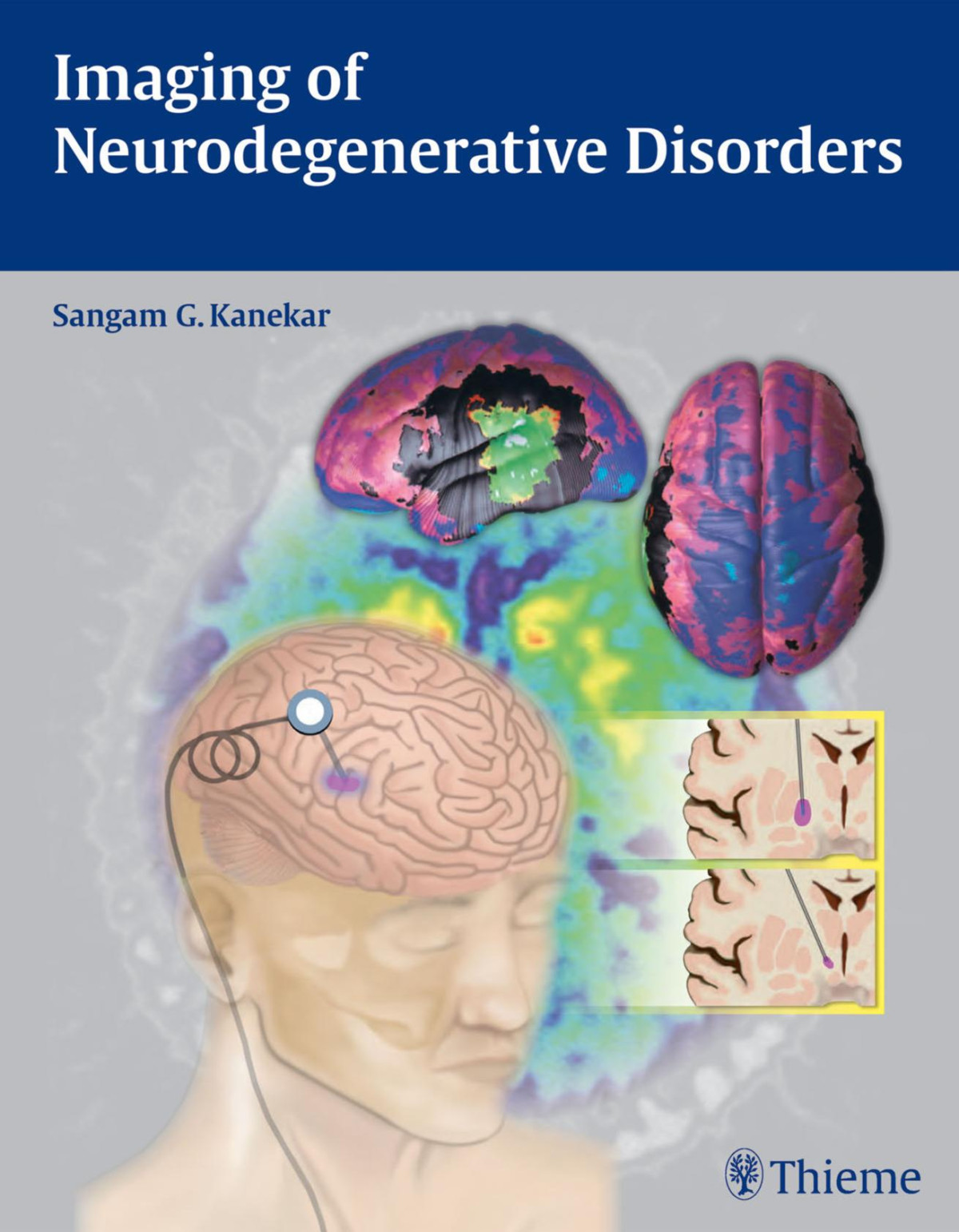 Imaging Of Neurodegenerative Disorders Sangam Kanekar