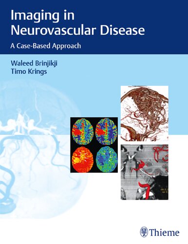 Imaging In Neurovascular Disease A Casebased Approach 1st Edition Waleed Brinjikji