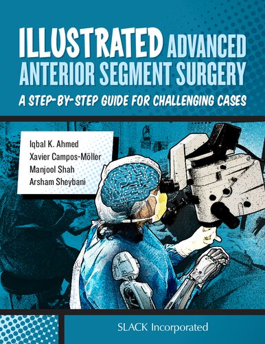 Illustrated Advanced Anterior Segment Surgery A Stepbystep Guide For Challenging Cases 1st Edition Iqbal K Ahmed Xavier Campos Mller Manjool Shah Arsham Sheybani