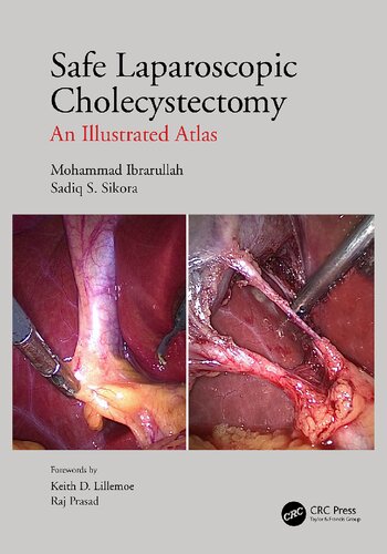 Safe Laparoscopic Cholecystectomy An Illustrated Atlas 1st Edition Mohammad Ibrarullah