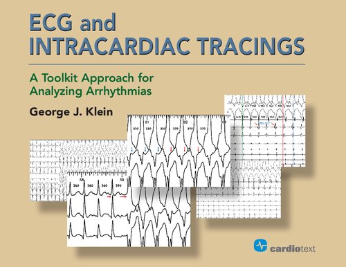 Ecg And Intracardiac Tracings A Toolkit Approach For Analyzing Arrhythmias 1st Edition George J Klein