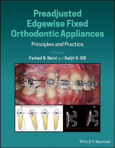 Preadjusted Edgewise Fixed Orthodontic Appliances Principles And Practice Farhad B Naini