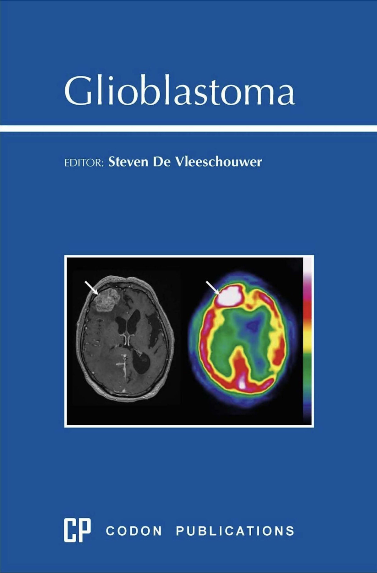 Glioblastoma Steven De Vleeschouwer