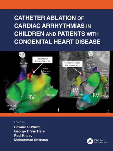 Catheter Ablation Of Cardiac Arrhythmias In Children And Patients With Congenital Heart Disease 1st Edition Walsh