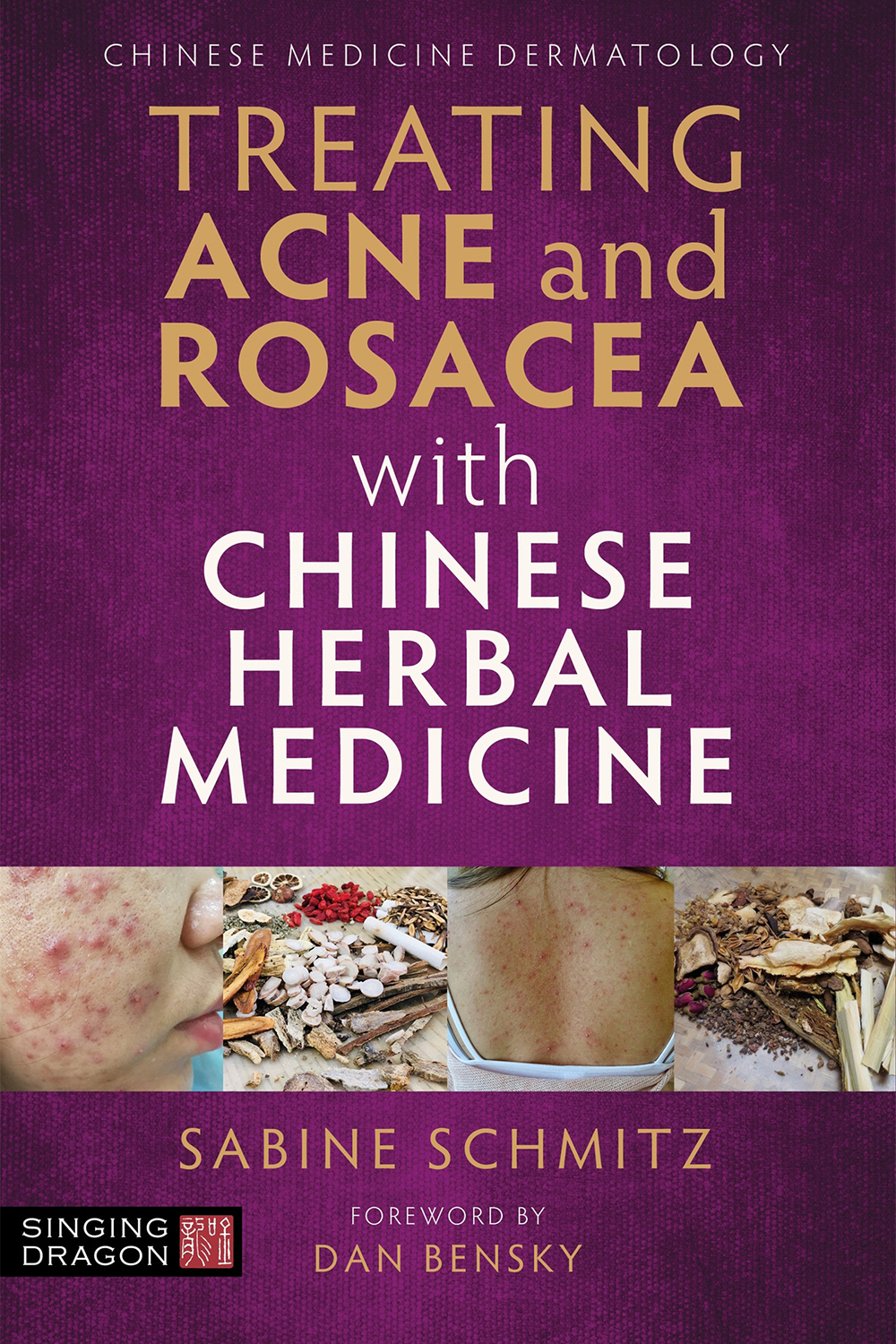 Treating Acne Rosacea With Chinese Herbal Medicine Sabine Schmitz