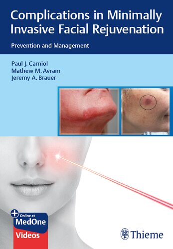 Complications In Minimally Invasive Facial Rejuvenation Prevention And Management 1st Edition Carniol