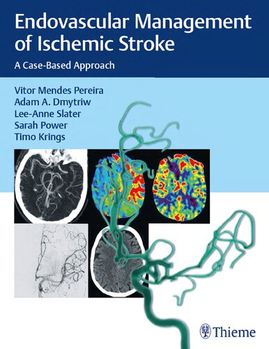 Endovascular Management Of Ischemic Stroke A Casebased Approach 1st Edition Vitor Mendes Pereira Adam A Dmytriw Leeanne Slater Sarah Power Timo Krings