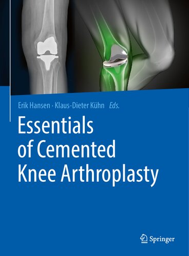 Essentials Of Cemented Knee Arthroplasty 1st Edition Erik Hansen