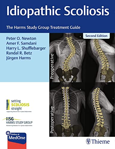 Idiopathic Scoliosis The Harms Study Group Treatment Guide 2nd Edition Peter Newton Editor