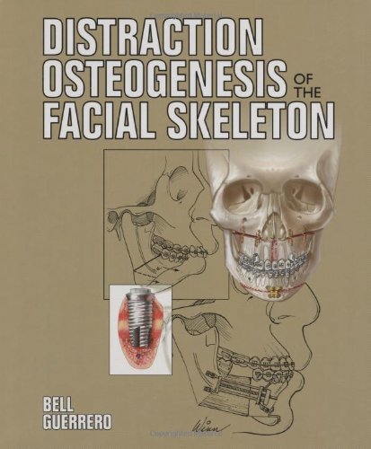 Distraction Osteogenesis Of The Facial Skeleton 1st Edition William H Bell