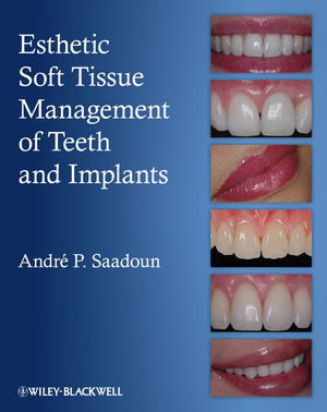Esthetic Soft Tissue Management Of Teeth And Implants Andre P Saadounauth
