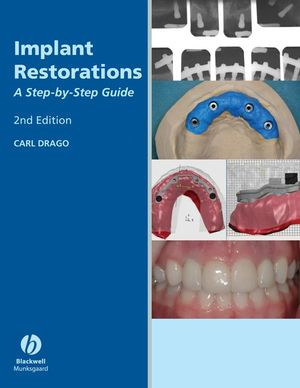 Implant Restorations A Stepbystep Guide 2nd Edition Carl Dragoauth