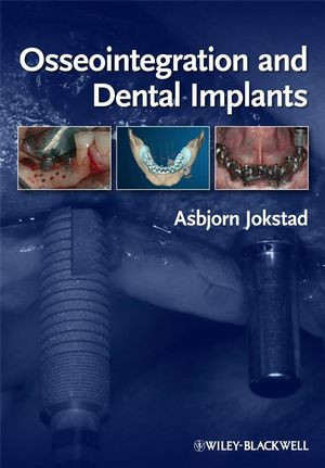 Osseointegration And Dental Implants