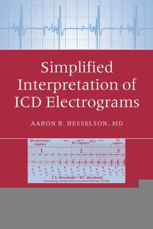 Simplified Interpretation Of Icd Electrograms Aaron B Hesselson