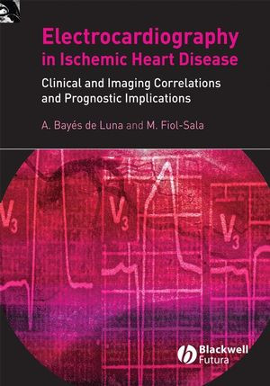 The Surface Electrocardiography In Ischaemic Heart Disease Clinical And Imaging Correlations And Prognostic Implications A Bayes De Luna