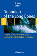 Nonunion Of The Long Bones Diagnosis And Treatment With Compressiondistraction Techniques 1st Edition Redento Mora