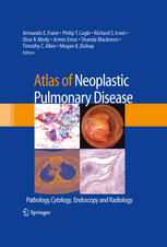 Atlas Of Neoplastic Pulmonary Disease Pathology Cytology Endoscopy And Radiology 1st Edition Megan K Dishop Md Auth