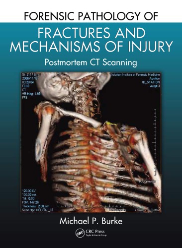 Forensic Pathology Of Fractures And Mechanisms Of Injury Postmortem Ct Scanning Michael P Burke