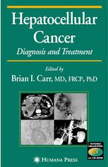 Hepatocellular Cancer Diagnosis And Treatment Jawad Ahmad Md
