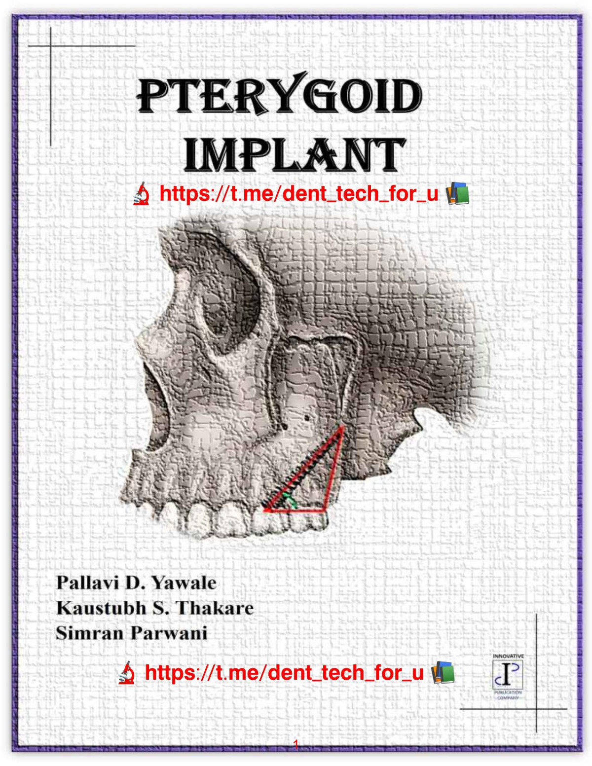 Pterygoid Implant Dr Pallavi D Yawale Dr Kaustubh S Thakare Dr Simran Parwani