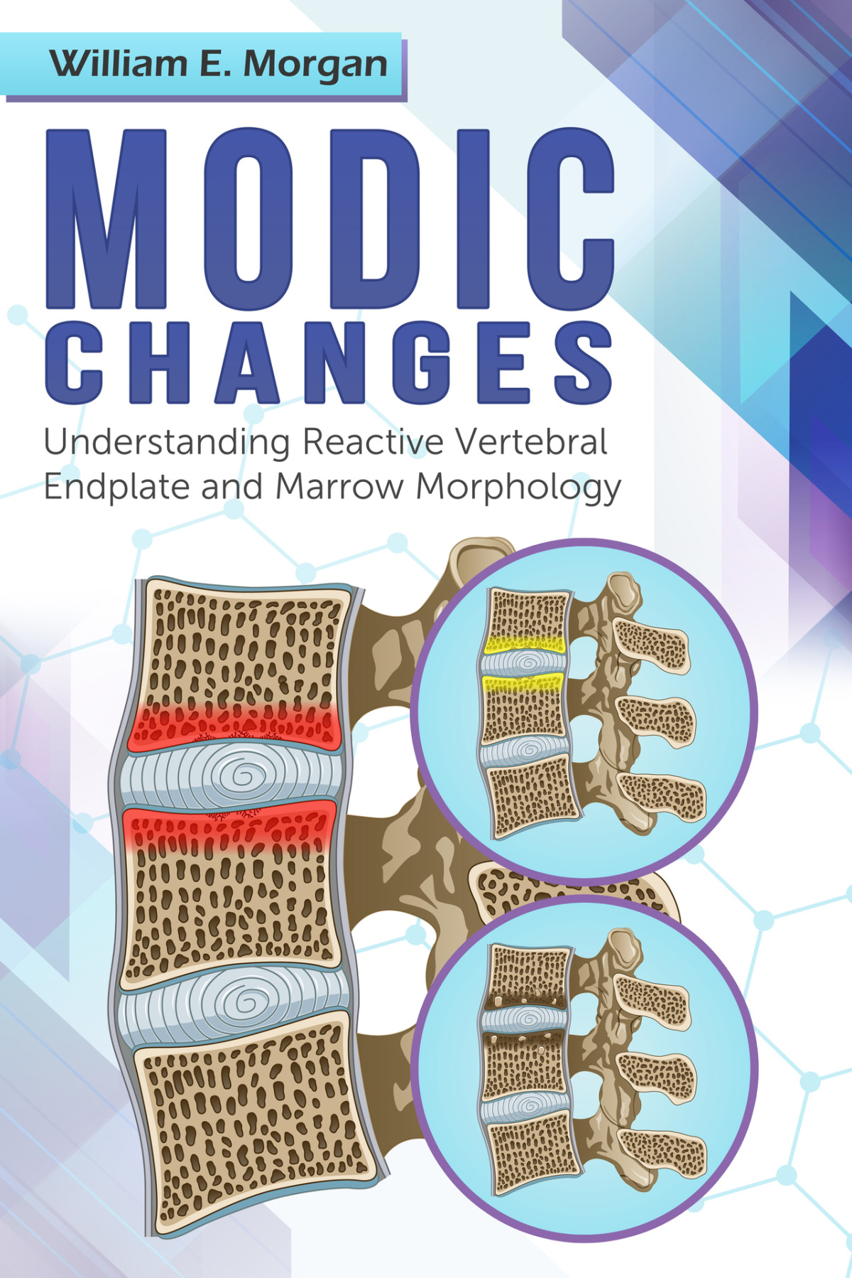 Modic Changes Understanding Reactive Vertebral Endplate And Marrow Morphology Morgan