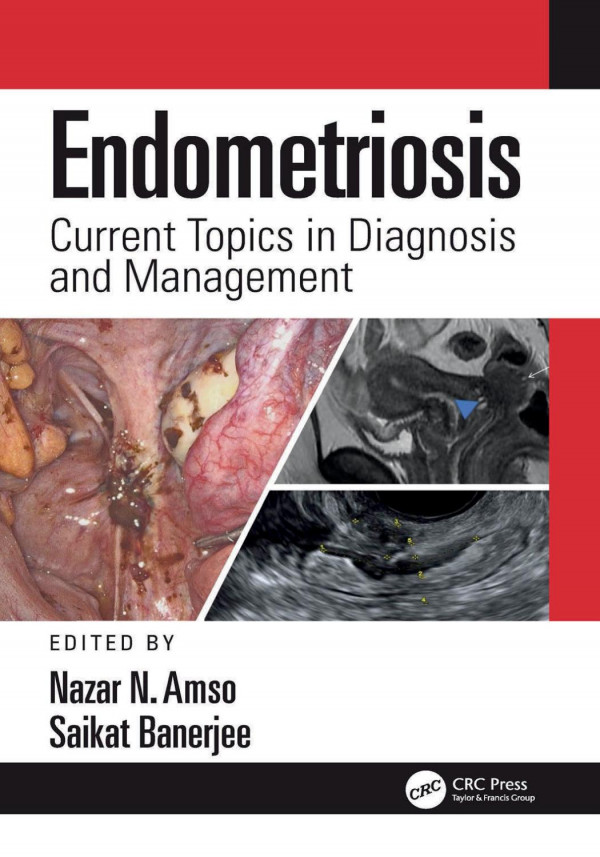 Endometriosis Current Topics In Diagnosis And Management Nazar Amso