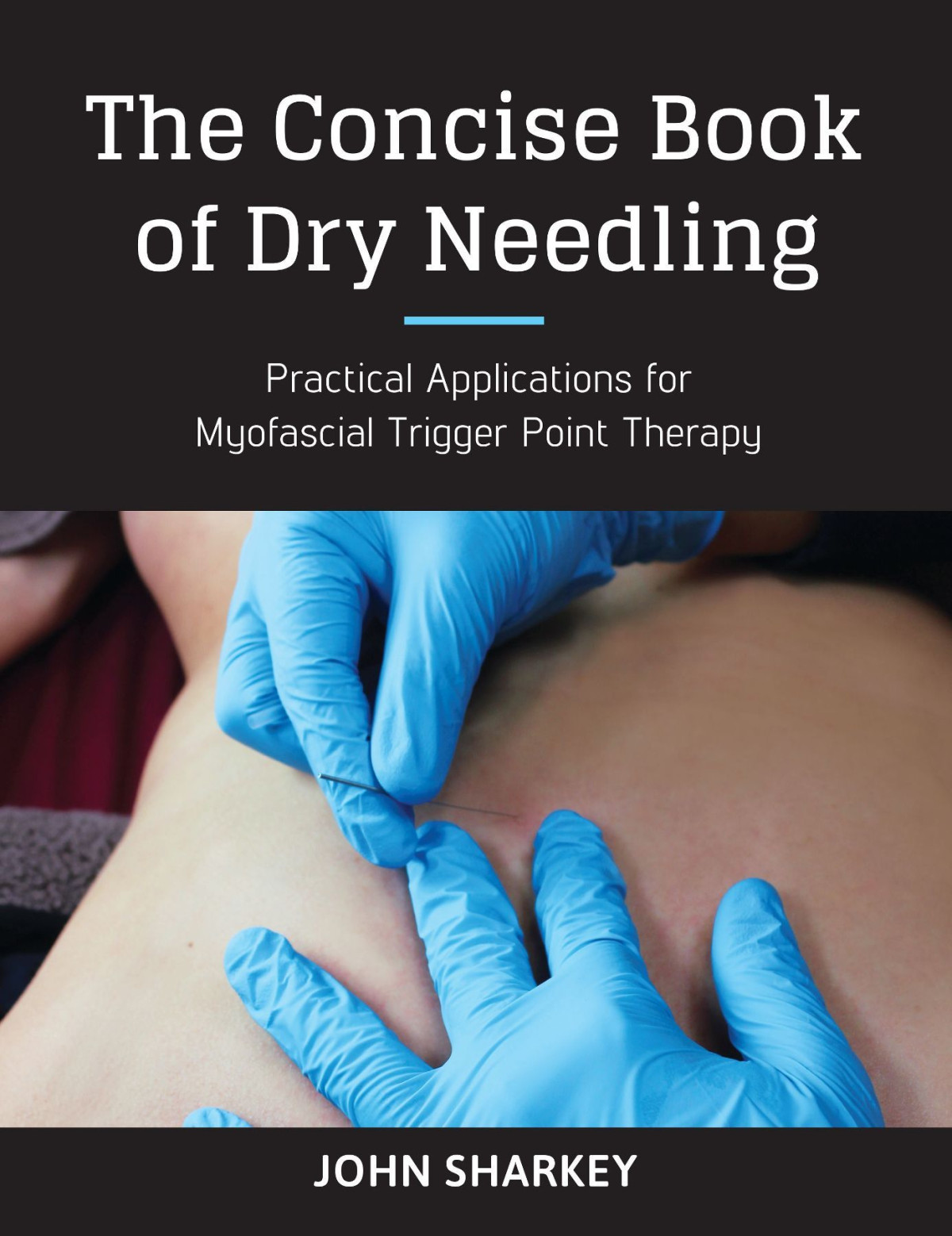 The Concise Book Of Dry Needling A Practitioners Guide To Myofascial Trigger Point Applications John Sharkey