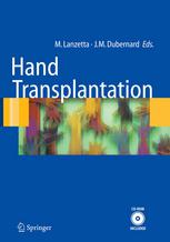 Hand Transplantation 1st Edition Bruce W Conolly Mario Benanzio Auth