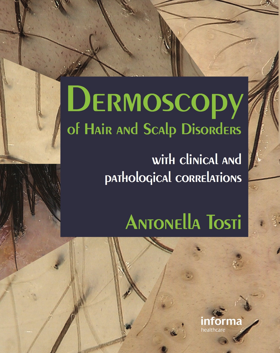 Dermoscopy Of Hair And Scalp Disorders With Clinical And Pathological Correlations 1st Edition Antonella Tosti