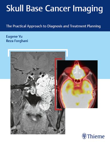 Skull Base Cancer Imaging The Practical Approach To Diagnosis And Treatment Planning Eugene Yu Ed Reza Forghani Ed