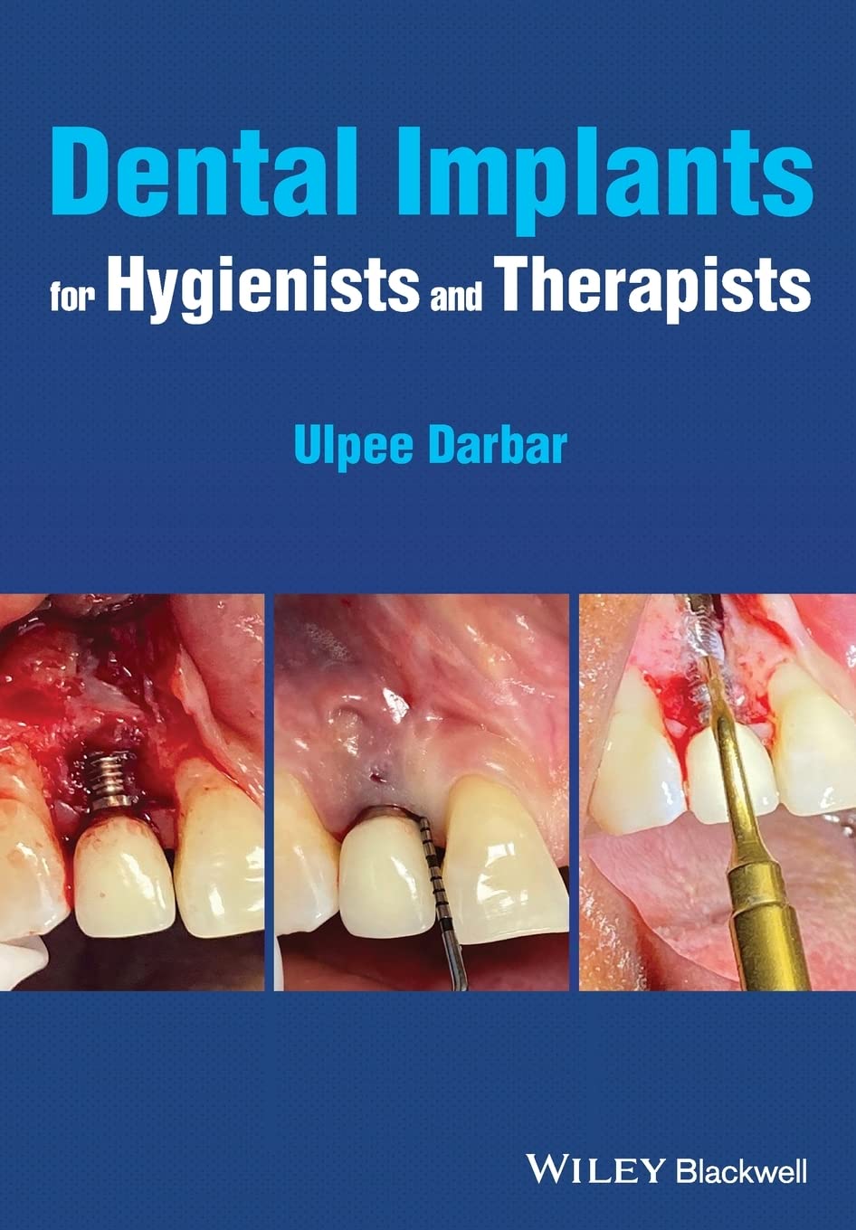 Dental Implants For Hygienists And Therapists Ulpee R Darbar