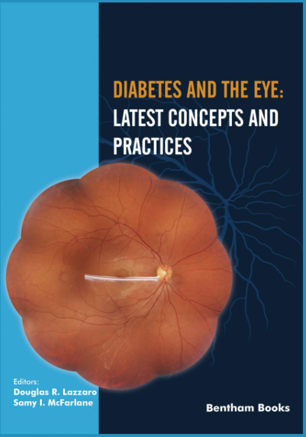 Diabetes And The Eye Douglas R Lazzaro