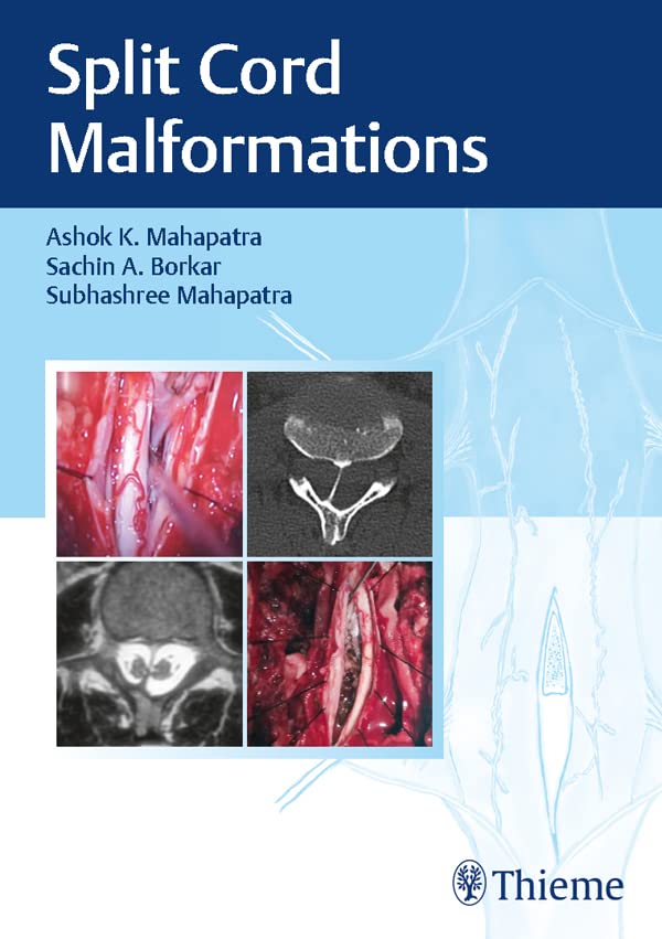 Split Cord Malformations 1st Edition Ashok K Mahapatra Sachin A Borkar