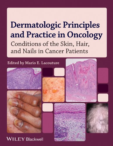 Dermatologic Principles And Practice In Oncology Conditions Of The Skin Hair And Nails In Cancer Patients 1st Edition Mario E Lacouture