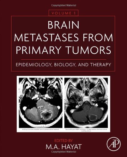 Brain Metastases From Primary Tumors Epidemiology Biology And Therapy 1st Edition M A Hayat Eds