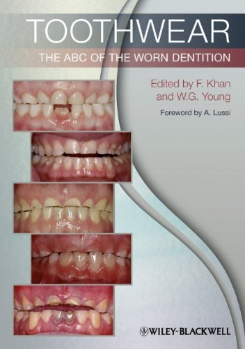 Toothwear The Abc Of The Worn Dentition 1st Edition Farid Khan