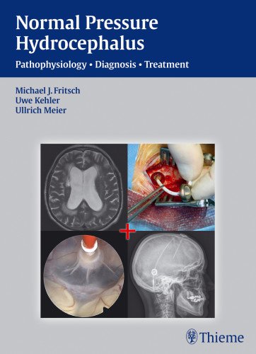 Nph Normal Pressure Hydrocephalus Pathophysiology Diagnosis Treatment 1st Edition Michael J Fritsch
