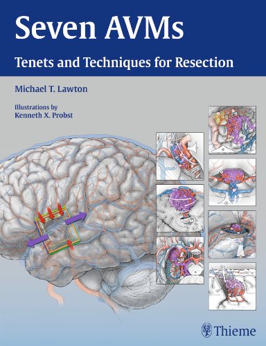Seven Avms Tenets And Techniques For Resection 1st Edition Michael T Lawton