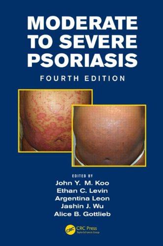 Moderate To Severe Psoriasis Fourth Edition 4th Edition John Y M Koo