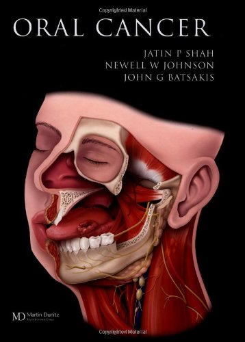 Oral Cancer Jatin P Mdjohnson Newell Wbatsaki John Shah