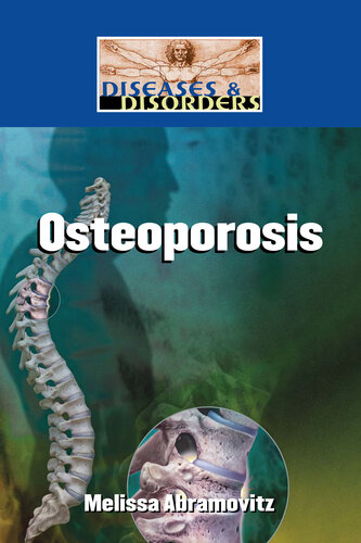 Osteoporosis Melissa Abramovitz