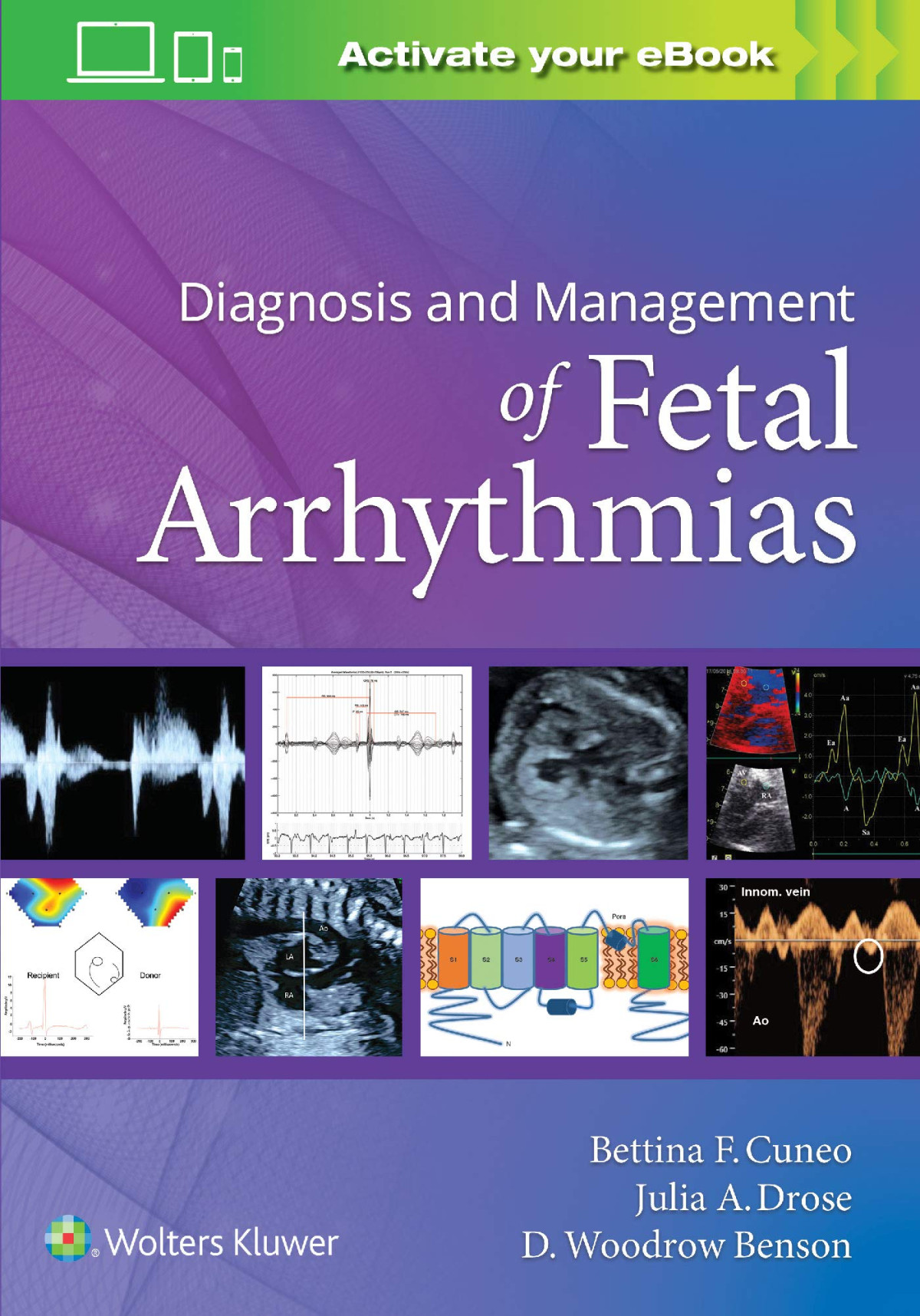 Diagnosis And Management Of Fetal Arrhythmias Bettina Cuneo Julia Drose