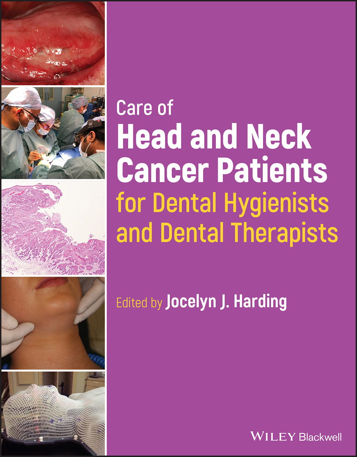 Care Of Head And Neck Cancer Patients For Dental Hygienists And Dental Therapists Jocelyn J Harding