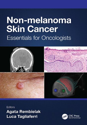 Nonmelanoma Skin Cancer Essentials For Oncologists 1st Edition Agata Rembielak Luca Tagliaferri