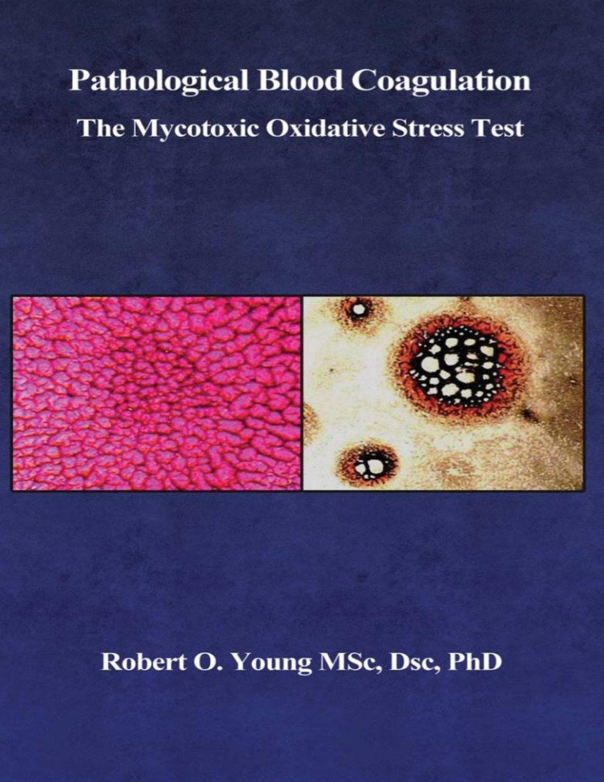 Pathological Blood Coagulation The Myxotoxic Oxidative Stress Test Robert Young