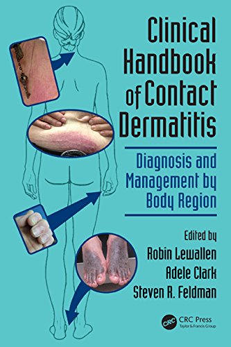 Clinical Handbook Of Contact Dermatitis Diagnosis And Management By Body Region Robin Lewallen