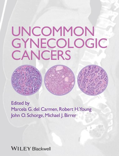 Uncommon Gynecologic Cancers 1st Edition Marcela Del Carmen John O Schorge