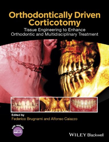Orthodontically Driven Corticotomy Tissue Engineering To Enhance Orthodontic And Multidisciplinary Treatment 1st Edition Federico Brugnami